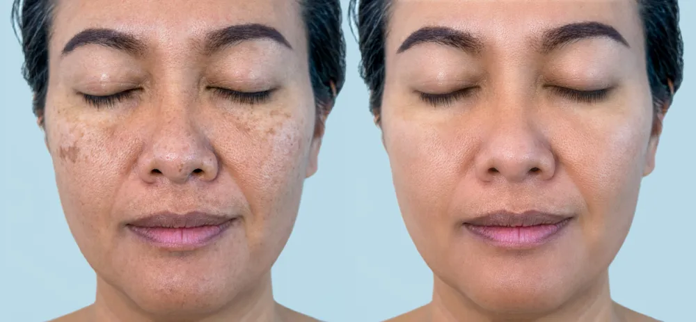 Pigmentation Treatment